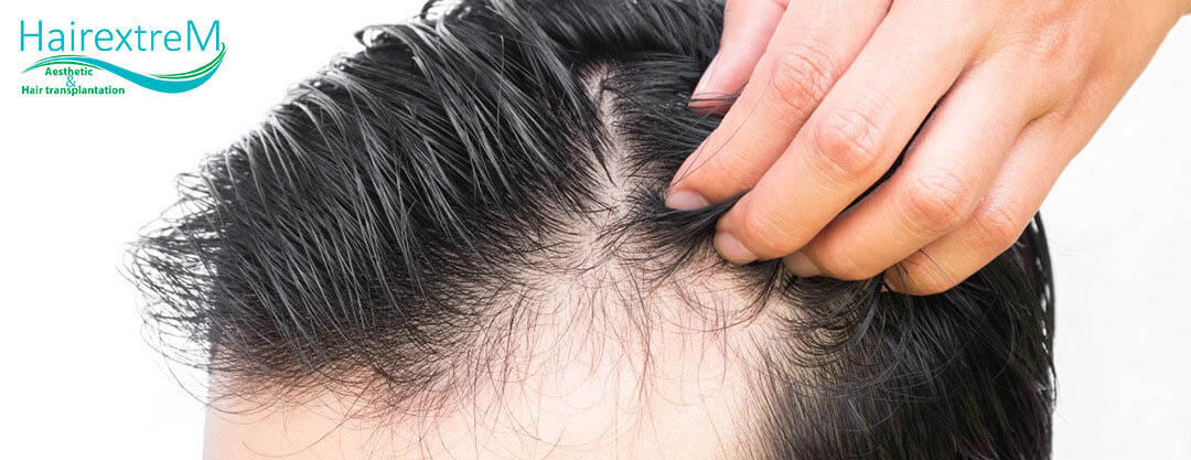 A qui s’adresse la greffe de cheveux sans rasage complet?