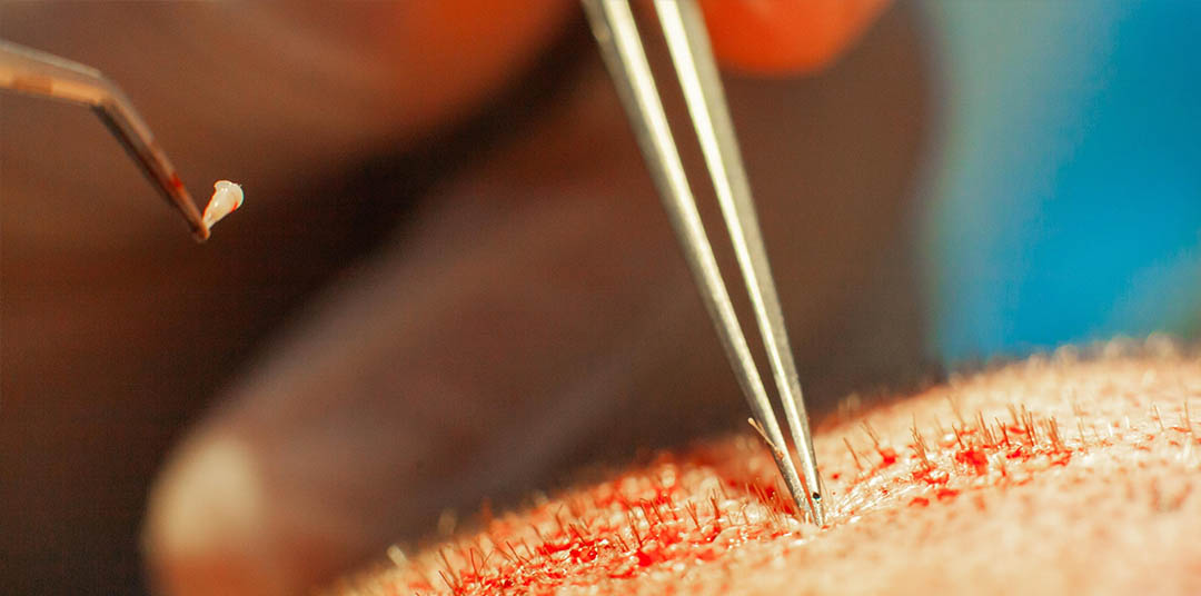 Beeinflussen Ihre Schlafgewohnheiten Ihren Haarausfall?