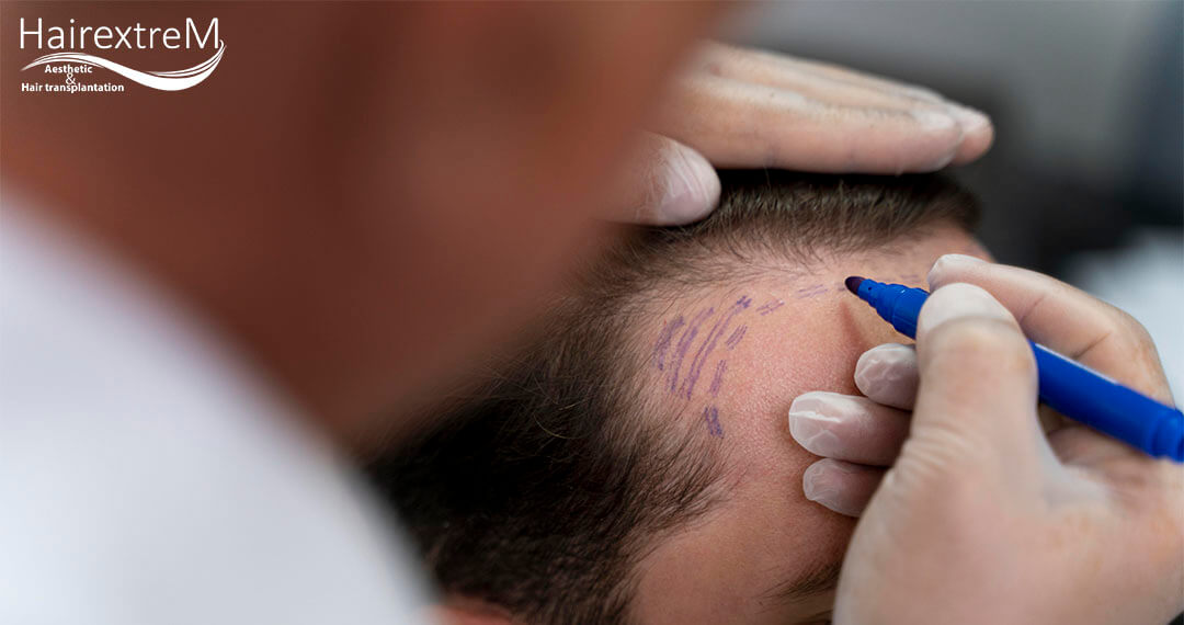 Bestes Haartransplantationszentrum in der Türkei 