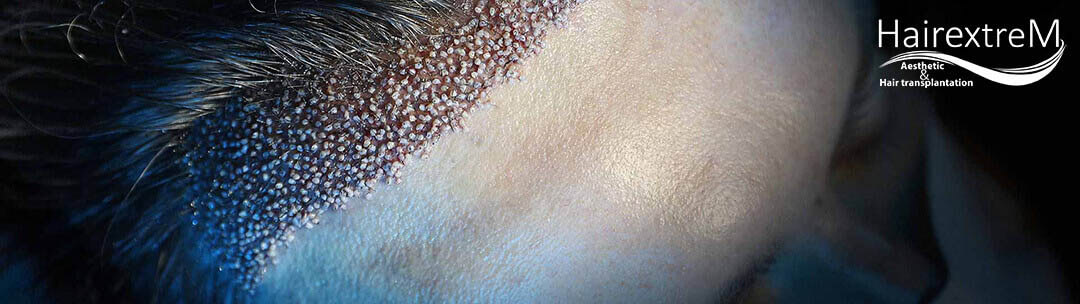 Combien de jours après la greffe de cheveux puis-je retourner au travail?