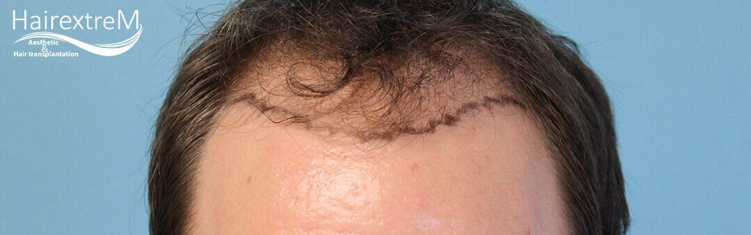 Comment les croûtes tombent-elles après une greffe de cheveux?