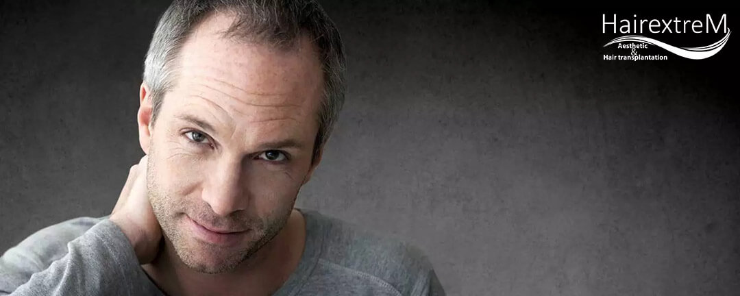 Comment se déroule une greffe de cheveux sur cheveux gris?