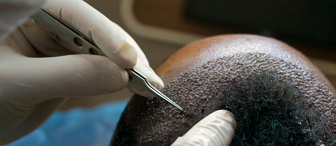 Dünnes Haar beim Mann Genetische Alopezie