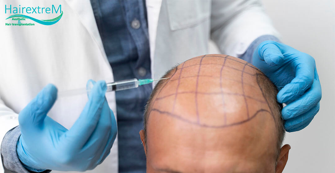 Führung zur Haartransplantation in der Türkei