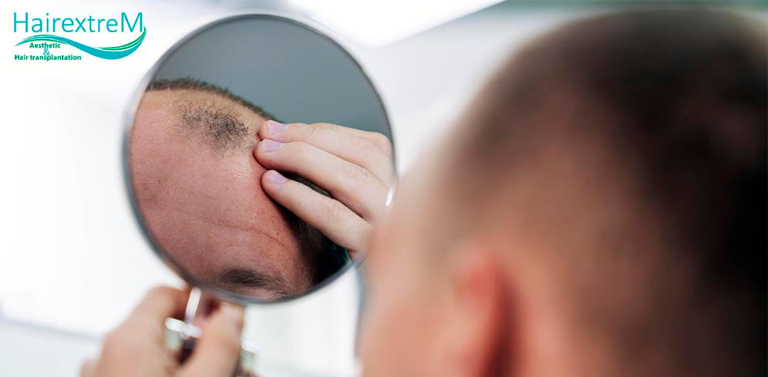 Guide de la greffe de cheveux en Turquie