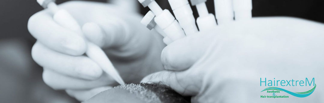 Ist Die Haartransplantation Ein Schmerzhafter Eingriff?