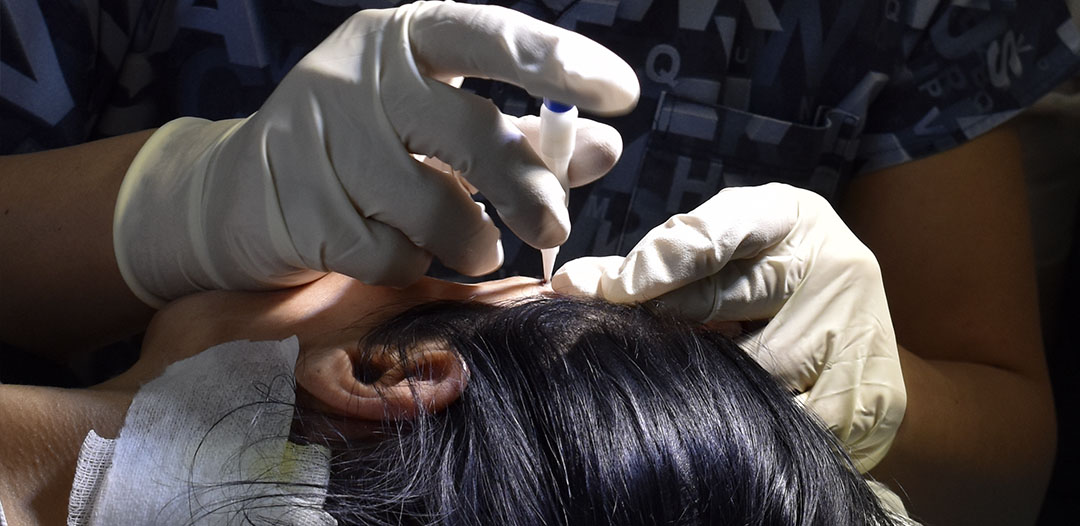 Kann erblich bedingter Haarausfall behandelt werden?