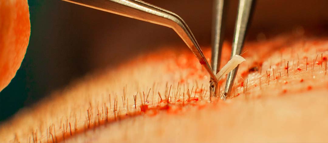 Kann Haarausfall durch Rauchen verursacht werden?