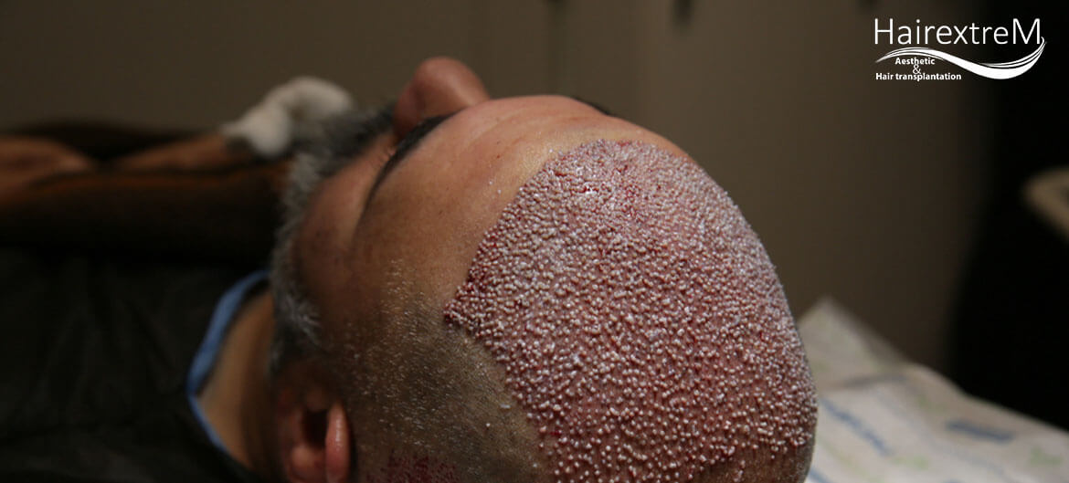 La procédure de greffe de cheveux chez un patient diabétique