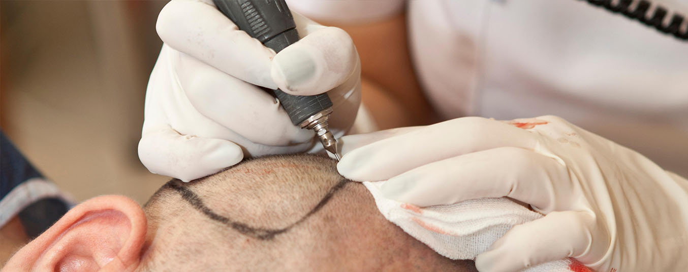 Les patients infectés par le VIH peuvent-ils avoir une greffe de cheveux?