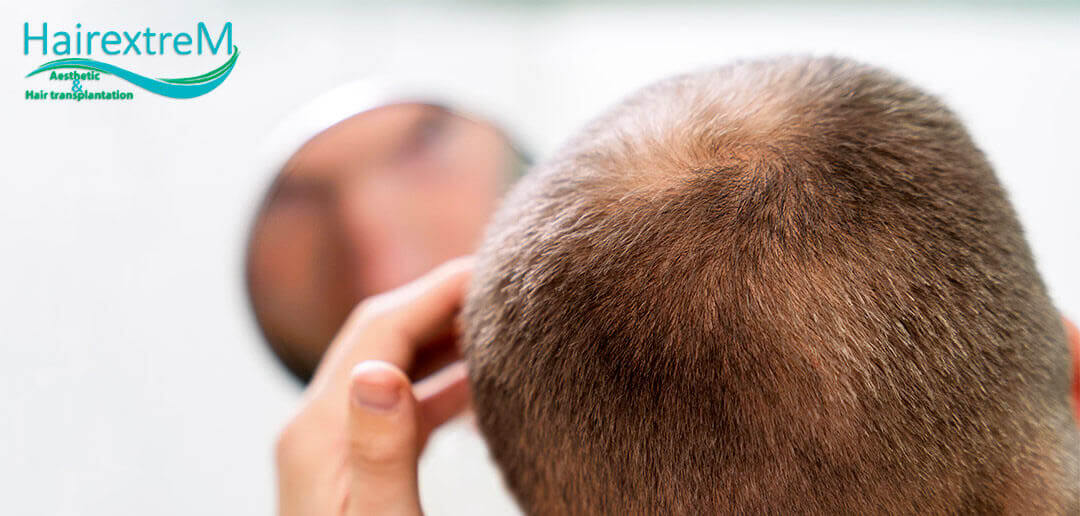 Preise für Haartransplantationen in der Türkei