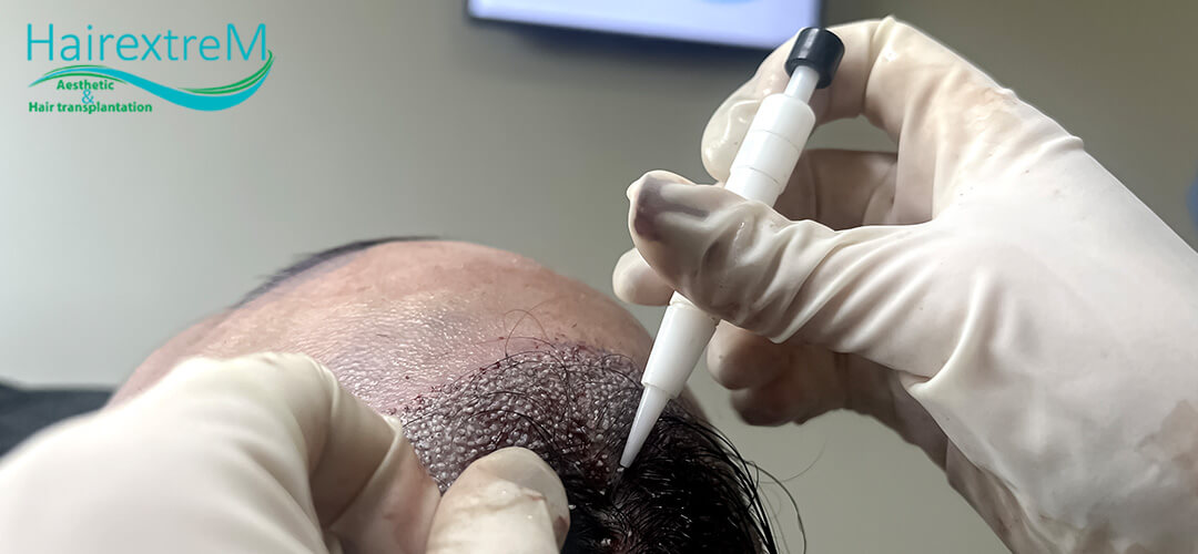 Qu'est-ce qu'un stylo Choi Implanter au sein d'une greffe de cheveux DHI