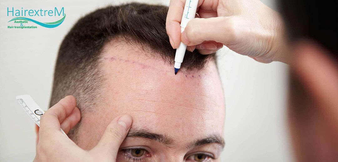 Quelle est la meilleure méthode de greffe de cheveux?