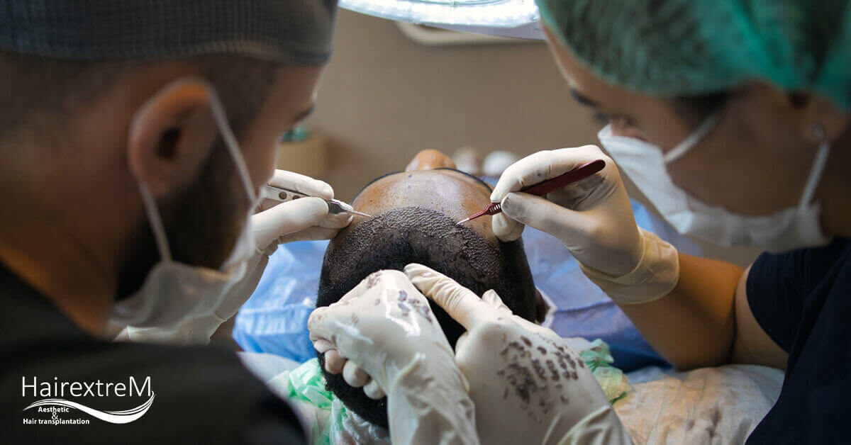 Wann kann ich eine zweite Haartransplantation durchführen lassen