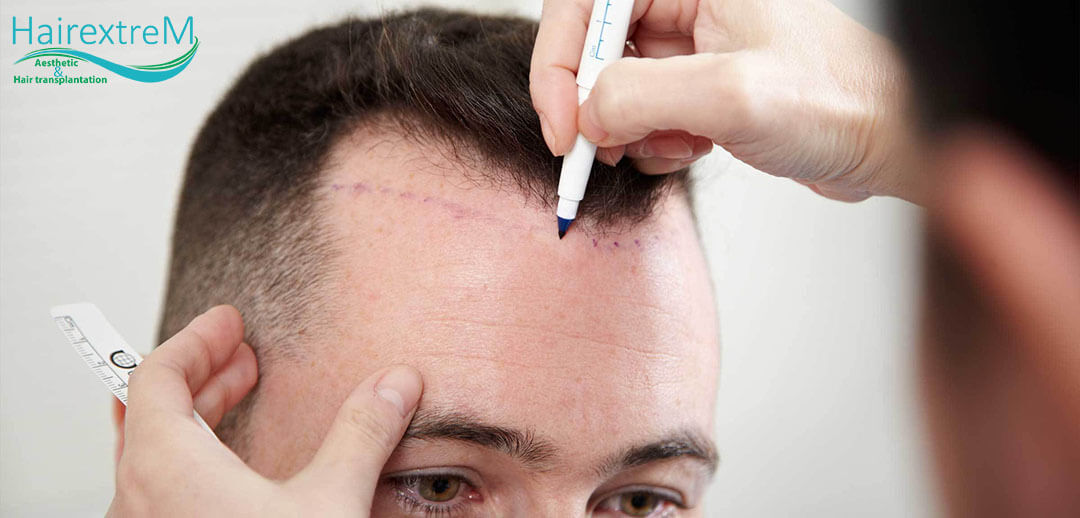 Wann ist das beste Alter für eine Haartransplantation?