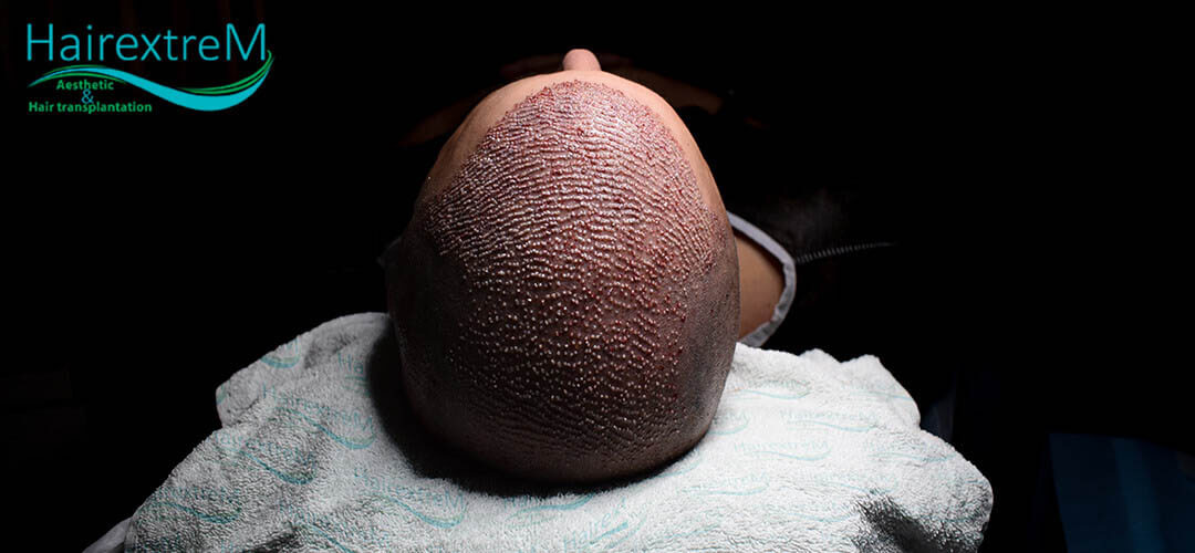 Warum sollten Sie vor und nach einer Haartransplantation auf Alkohol verzichten?