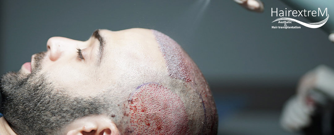 Was Ist Die Beste Haartransplantations Methode?