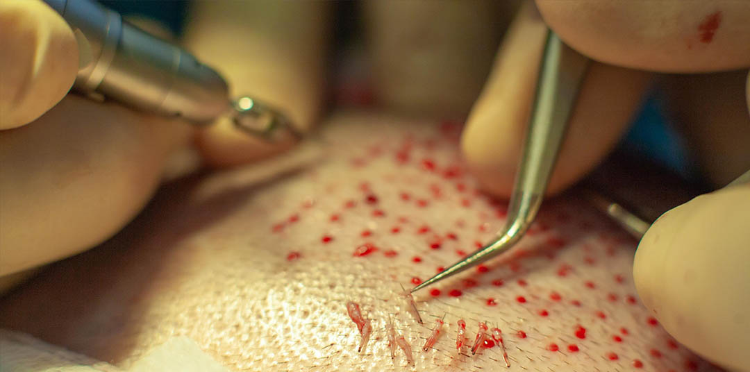 Welche Methoden und Techniken gibt es für die Haartransplantation?