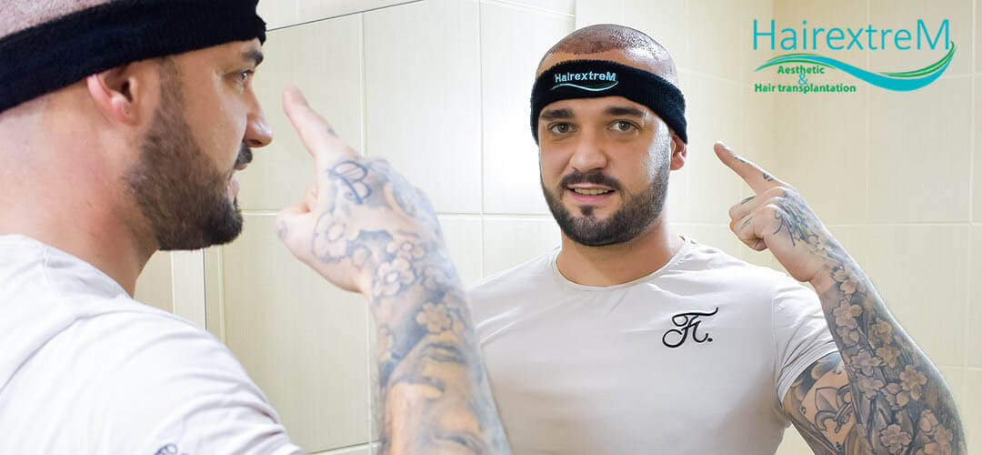 Wie lange hält eine Haartransplantation?