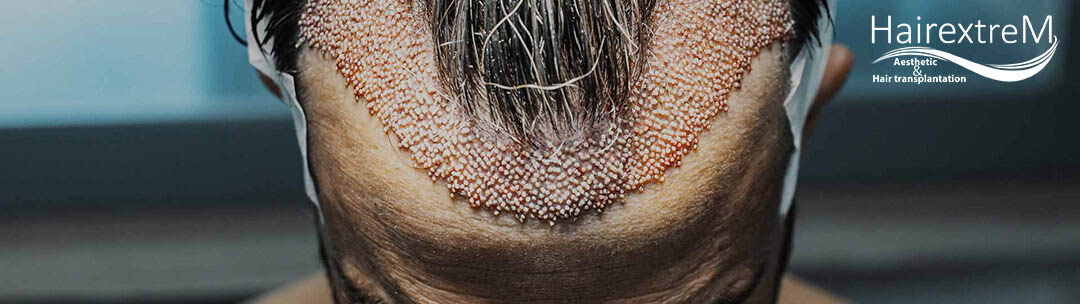 Wie viele Grafts werden bei einer Haartransplantation benötigt?