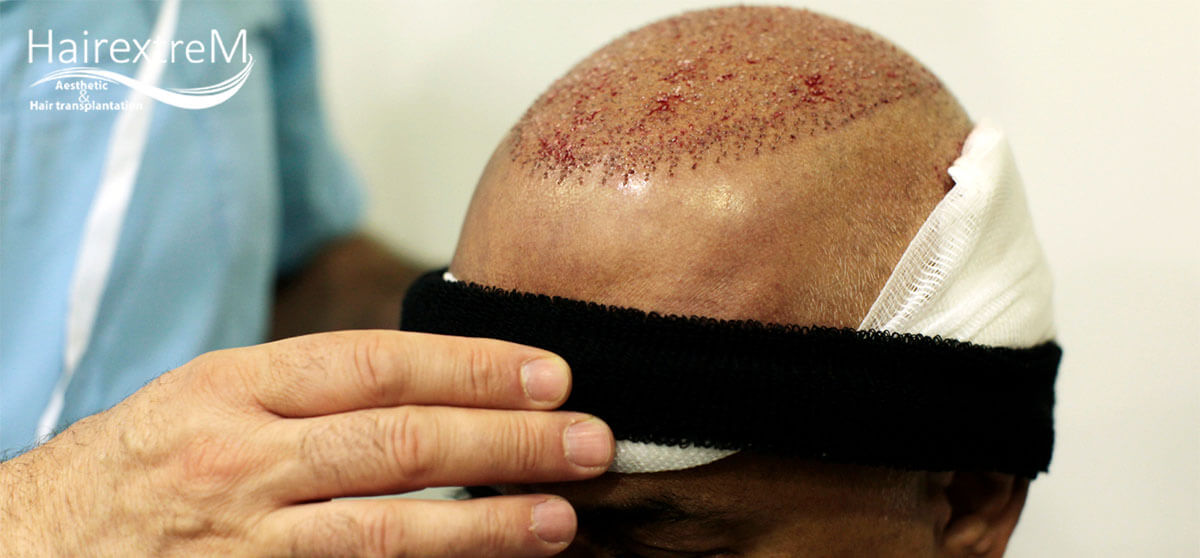 Wo ist der beste Ort der Welt für eine Haartransplantation