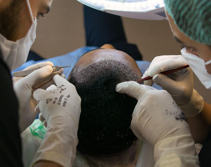 زراعة الشعر