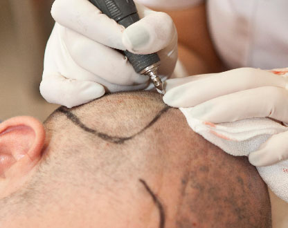 زراعة الشعر DHI