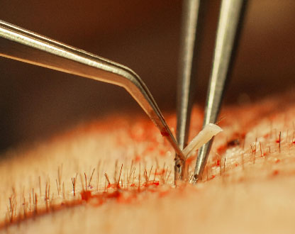 Sapphire FUE زراعة الشعر