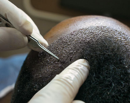 زراعة الشعر FUE