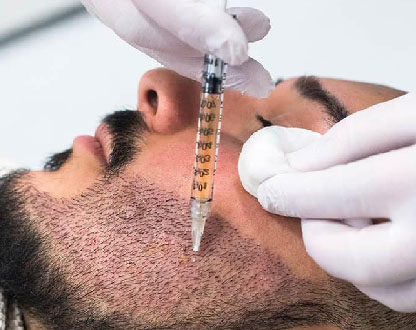 زراعة اللحية