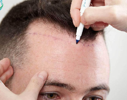 زراعة الشعر بدون حلاقة